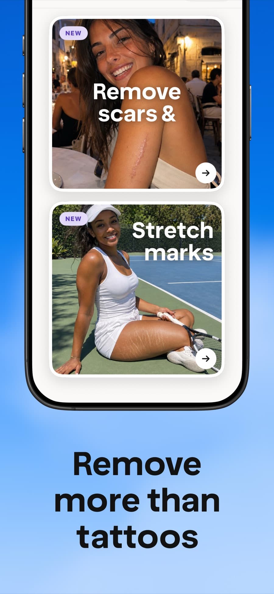 Remove more than tattoos: scars and stretch marks